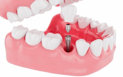 Prótese Dentária